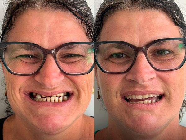 Múltiplos Implantes
